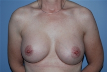 Breast Augmentation After Photo by Lucie Capek, MD; Cohoes, NY - Case 21501