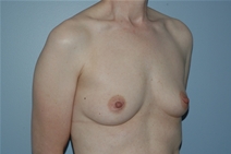 Breast Augmentation Before Photo by Lucie Capek, MD; Cohoes, NY - Case 21501