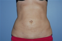 Liposuction After Photo by Lucie Capek, MD; Cohoes, NY - Case 22364