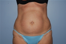 Liposuction Before Photo by Lucie Capek, MD; Cohoes, NY - Case 22364