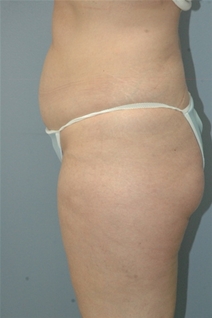 Liposuction Before Photo by Lucie Capek, MD; Latham, NY - Case 22369
