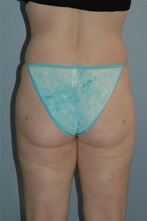 Liposuction After Photo by Lucie Capek, MD; Cohoes, NY - Case 22369