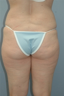 Liposuction Before Photo by Lucie Capek, MD; Cohoes, NY - Case 22369