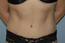 Tummy Tuck After Photo by Lucie Capek, MD; Cohoes, NY - Case 22415