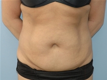 Tummy Tuck Before Photo by Lucie Capek, MD; Cohoes, NY - Case 22415