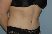 Tummy Tuck After Photo by Lucie Capek, MD; Cohoes, NY - Case 22415