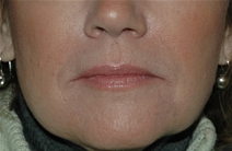 Dermal Fillers After Photo by Lucie Capek, MD; Cohoes, NY - Case 22418