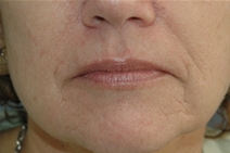 Dermal Fillers Before Photo by Lucie Capek, MD; Cohoes, NY - Case 22418