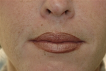 Dermal Fillers After Photo by Lucie Capek, MD; Cohoes, NY - Case 22420