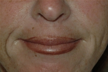Dermal Fillers Before Photo by Lucie Capek, MD; Latham, NY - Case 22420