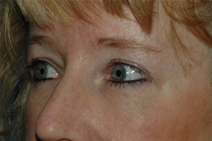 Eyelid Surgery After Photo by Lucie Capek, MD; Cohoes, NY - Case 22440