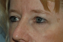 Eyelid Surgery Before Photo by Lucie Capek, MD; Cohoes, NY - Case 22440