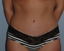 Tummy Tuck After Photo by Lucie Capek, MD; Latham, NY - Case 22936