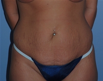 Tummy Tuck Before Photo by Lucie Capek, MD; Latham, NY - Case 22936