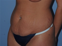 Tummy Tuck Before Photo by Lucie Capek, MD; Latham, NY - Case 22936