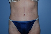 Tummy Tuck After Photo by Lucie Capek, MD; Cohoes, NY - Case 22941