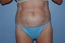 Tummy Tuck Before Photo by Lucie Capek, MD; Cohoes, NY - Case 22941