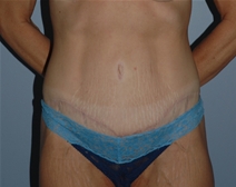 Tummy Tuck After Photo by Lucie Capek, MD; Cohoes, NY - Case 22942