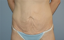 Tummy Tuck Before Photo by Lucie Capek, MD; Cohoes, NY - Case 22942