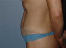 Tummy Tuck After Photo by Lucie Capek, MD; Cohoes, NY - Case 22942