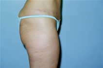 Dermal Fillers Before Photo by Lucie Capek, MD; Latham, NY - Case 22943