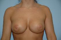 Breast Augmentation After Photo by Lucie Capek, MD; Cohoes, NY - Case 8702