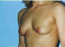 Breast Augmentation Before Photo by Lucie Capek, MD; Cohoes, NY - Case 8702