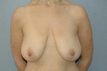 Breast Lift Before Photo by Lucie Capek, MD; Cohoes, NY - Case 8703