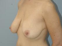 Breast Lift Before Photo by Lucie Capek, MD; Cohoes, NY - Case 8703