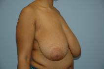 Breast Reduction Before Photo by Lucie Capek, MD; Cohoes, NY - Case 8705