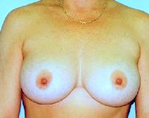 Breast Augmentation After Photo by Lucie Capek, MD; Cohoes, NY - Case 8706