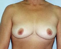 Breast Augmentation Before Photo by Lucie Capek, MD; Cohoes, NY - Case 8706