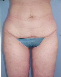 Liposuction After Photo by Lucie Capek, MD; Cohoes, NY - Case 8740
