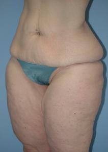 Liposuction Before Photo by Lucie Capek, MD; Cohoes, NY - Case 8740