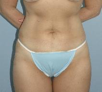 Liposuction After Photo by Lucie Capek, MD; Cohoes, NY - Case 8741