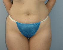 Liposuction Before Photo by Lucie Capek, MD; Cohoes, NY - Case 8741