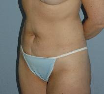 Liposuction After Photo by Lucie Capek, MD; Latham, NY - Case 8741