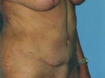 Tummy Tuck After Photo by Lucie Capek, MD; Cohoes, NY - Case 8743