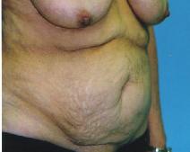 Tummy Tuck Before Photo by Lucie Capek, MD; Cohoes, NY - Case 8743