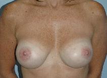 Breast Augmentation After Photo by Lucie Capek, MD; Cohoes, NY - Case 8744