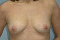 Breast Augmentation Before Photo by Lucie Capek, MD; Cohoes, NY - Case 8744