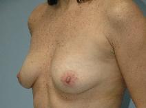 Breast Augmentation Before Photo by Lucie Capek, MD; Latham, NY - Case 8744
