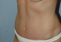 Tummy Tuck After Photo by Lucie Capek, MD; Cohoes, NY - Case 8745