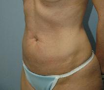 Tummy Tuck Before Photo by Lucie Capek, MD; Cohoes, NY - Case 8745