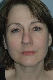 Facelift After Photo by Lucie Capek, MD; Cohoes, NY - Case 8835