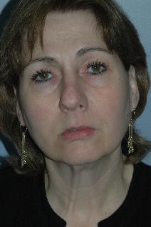 Facelift Before Photo by Lucie Capek, MD; Cohoes, NY - Case 8835