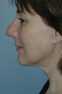 Facelift After Photo by Lucie Capek, MD; Latham, NY - Case 8835