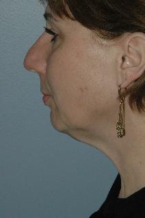 Facelift Before Photo by Lucie Capek, MD; Latham, NY - Case 8835