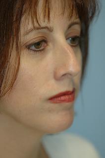 Rhinoplasty Before Photo by Lucie Capek, MD; Cohoes, NY - Case 8836