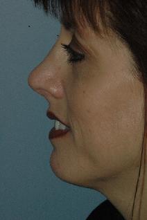 Rhinoplasty After Photo by Lucie Capek, MD; Latham, NY - Case 8836
